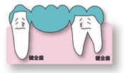 従来の治療：歯が中間で1本抜けた場合