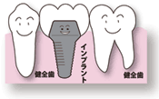インプラント治療：歯が中間で1本抜けた場合