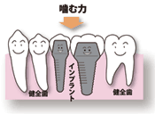 インプラント治療：歯が中間で2本抜けた場合