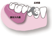 従来の治療：奥歯が数本抜けた場合