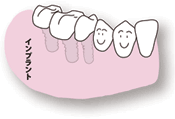 インプラント治療：奥歯が数本抜けた場合